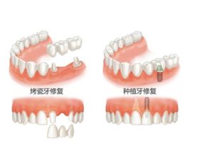 全口种植牙临时牙和永久牙冠的区别(种植 临时牙)