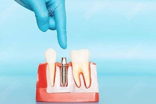 3M树脂补牙材料型号有哪几种 详解3M树脂补牙型号 优缺点及价格