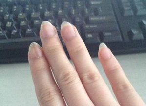 无名指指甲上有一条黑线竖纹是什么原因呀 