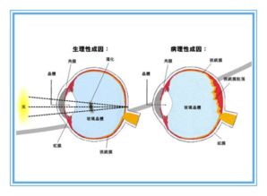 玻璃体混浊是怎么回事? 等