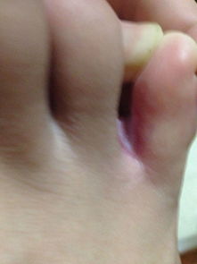 小脚趾和无名脚趾中间的缝非常痛,好像发炎似的,怎么办 急 