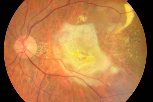 视网膜色素变性怎么治疗最有效 