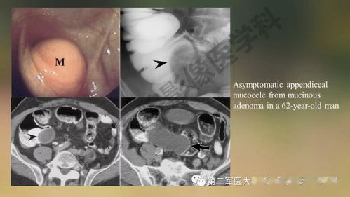 阑尾常见原发肿瘤影像学表现