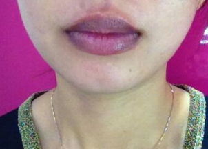 女人嘴唇发紫是什么病图片