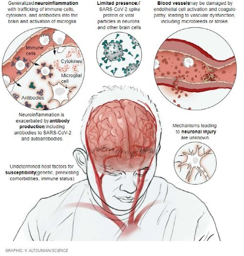 患新冠后遗症出现脑损伤的原因（严重新冠感染可致大脑损伤） 第1张
