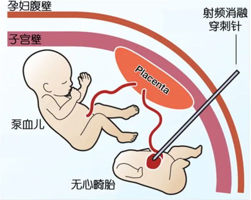 双胎妊娠遇上“无心胎”，国妇婴医护接力完成宫内急救