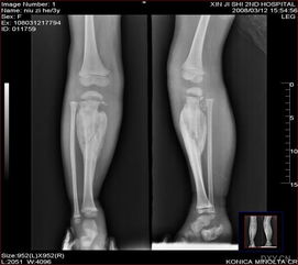 胫骨骨折图片 图片欣赏中心 急不急图文 Jpjww Com
