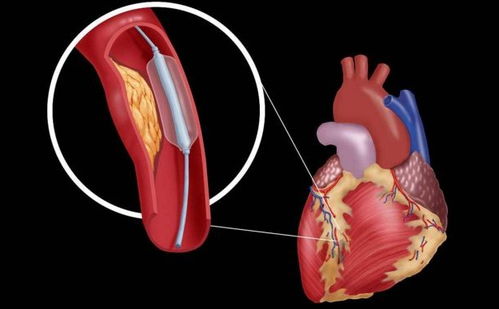 心脏病人要如何护理 心脏病有哪些危害
