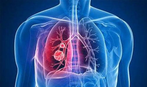 肺腺癌病原理分析,肺腺癌是怎么形成的呢