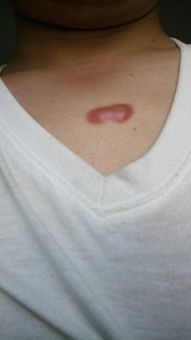 疤痕增生症怎么治疗 有个小疙瘩,在胸口前