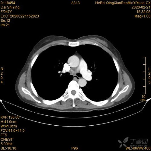 诊断 肺癌 手术切除,病理检查不是肺癌,看看是什么病 俱乐部3