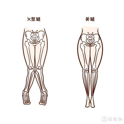 女人双腿合不拢 如何有效矫正X型腿 OX型腿 