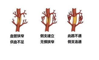 心肌一旦坏死就不可逆,为啥心肌梗死后还要放支架 医生这次说清了