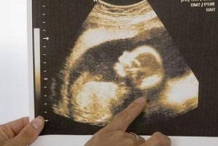 看早期孕囊形状看男女准吗