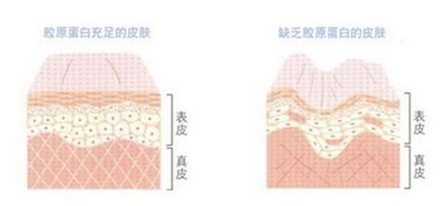 微整形选择的材料以及历史的发展 从奥美定到玻尿酸 胶原蛋白