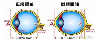 假性近视怎么会导致眼轴异常？