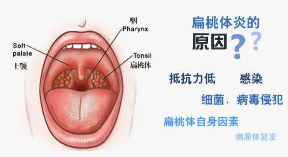 扁桃体肥大是怎么引起的