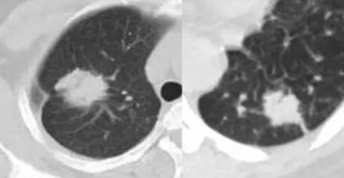 结核瘤 VS 周围型肺癌