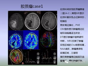 关于磁共振 MRI 检查,患者关心的问题都在这里