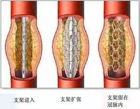 为什么一些心脏支架贵的吓人，成本价格便宜