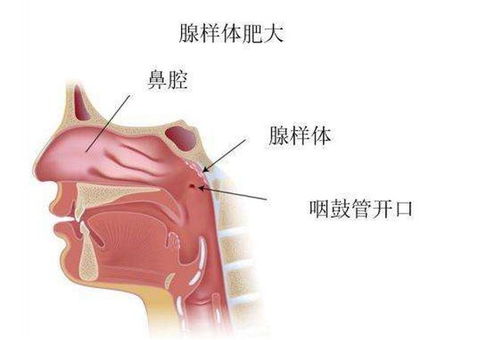 做腺样体手术,是一劳永逸么