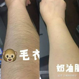 全身突然长汗毛 20岁女生是什么原因 怎么办 