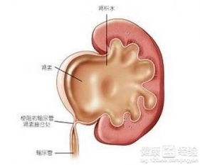 肾积水不手术能治愈吗