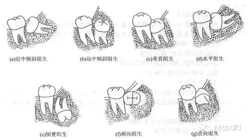 拔智齿伤神经吗 