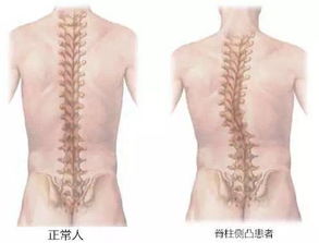 脊柱侧弯是什么如何纠正腹式呼吸有用吗