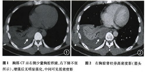 以血性胸腔积液为主要表现的右侧叶外型肺隔离症一例 