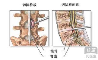 腰间盘突出要怎么办 腰间盘引起的原因