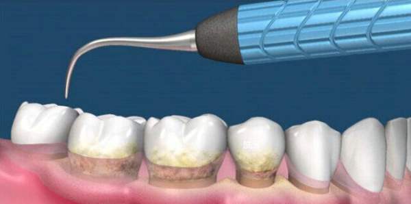 世卫组织 新冠疫情期间建议牙科诊所取消洗牙等常规服务