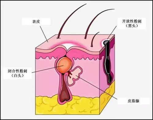 痘痘挤出来一粒白色的是怎么回事