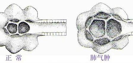 肺气肿吃什么食物好