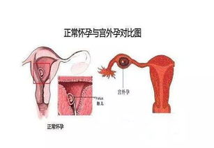 8个征兆说明你宫外孕了(宫外孕发病前的征兆有哪些哪些病症表明有宫外孕的可能)