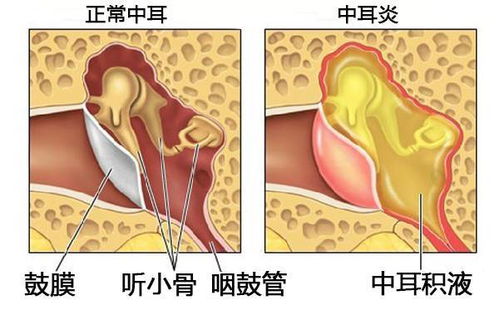 贵阳铭仁耳鼻喉医院 你一定要知道 耳科常见病 急性化脓性中耳炎