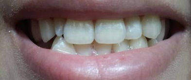 下牙不齐准备做正畸,医生说上牙的一颗侧切牙是畸形牙,说有两种方案,都是拔4颗 ①上牙拔掉侧切牙, 