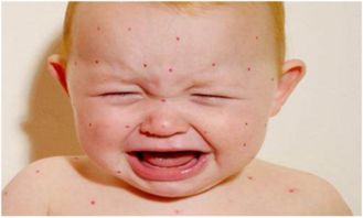 宝宝湿疹(婴儿湿疹有什么办法根治)