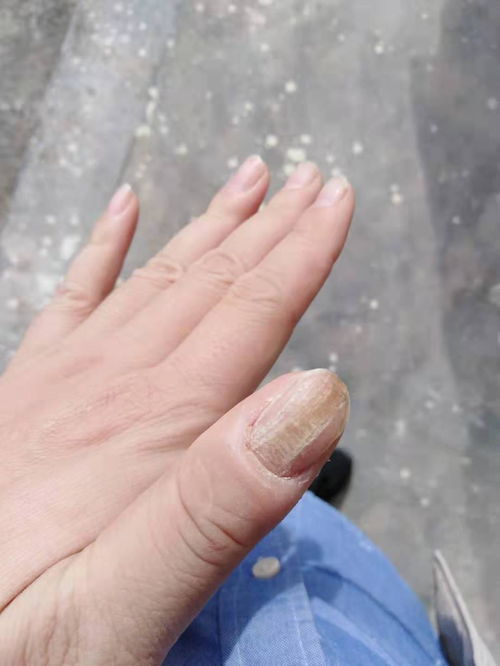 手大拇指指甲凹凸不平,有褶皱是啥原因,怎么治疗 