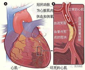 心肌缺血怎样预防