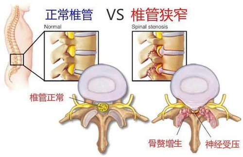 腰椎管狭窄怎么办 微创治疗效果好