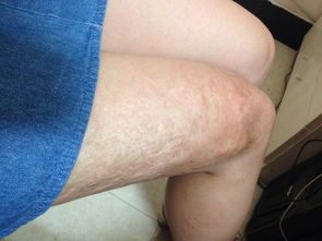 人们看到一个腿上有烫伤疤痕的女孩会怎么想呢 