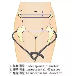 骨盆外测量(骨盆外测量临床意义)