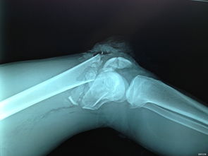 左股骨下段开放性粉碎性骨折 左小腿室筋膜综合症 骨科专业讨论版 