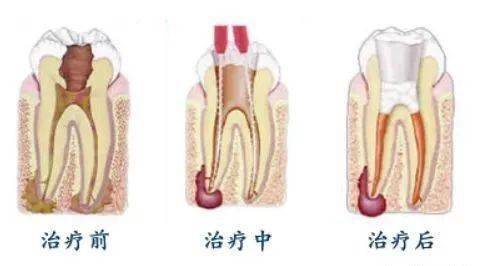 根管治疗后戴个牙冠,太重要了