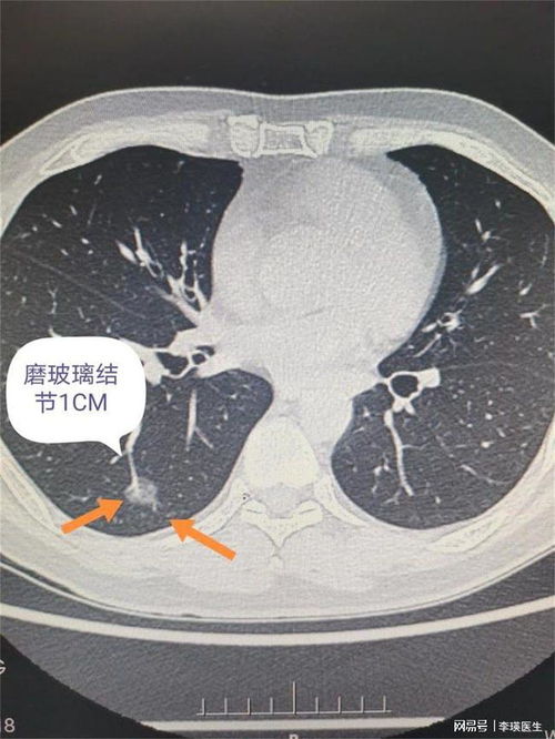 肺部CT多久做一次合适 这些肺部CT通俗易懂的解释,建议收藏
