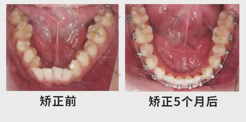 改变命运的不止刚刚的高考,还有牙齿矫正