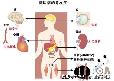 中科西部研究院 干细胞治疗2型糖尿病最新临床进展