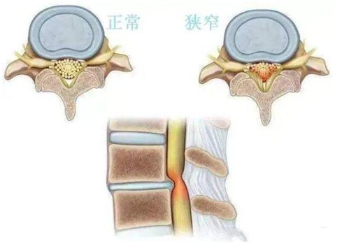 查出腰椎管狭窄,可以采用按摩吗(查出腰椎管狭窄,可以采用按摩吗图片)