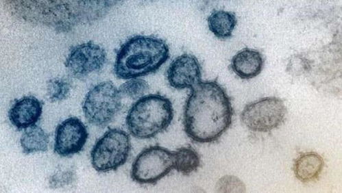 美国疾控中心公布新冠病毒症状新增6种，不再局限于发热，咳嗽